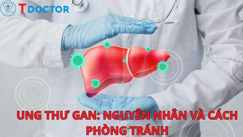 Tdoctor - Ung thư gan: Nguyên nhân, triệu chứng, điều trị và cách phòng tránh